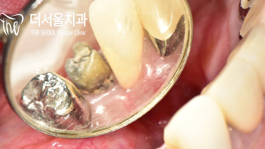 An Old Gold Crown That Started to Smell: Replacing It With Zirconia