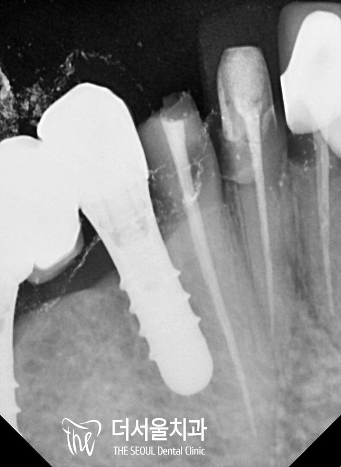 Close-up dental X-ray showing a crowned tooth with a post inside the root
