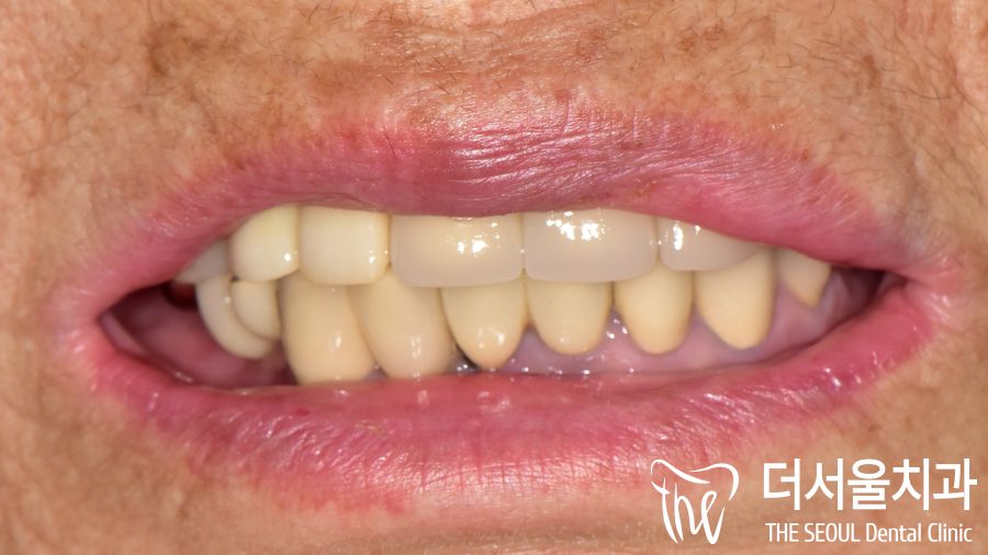 Close-up photograph of the mouth at lip level with the new crown in place