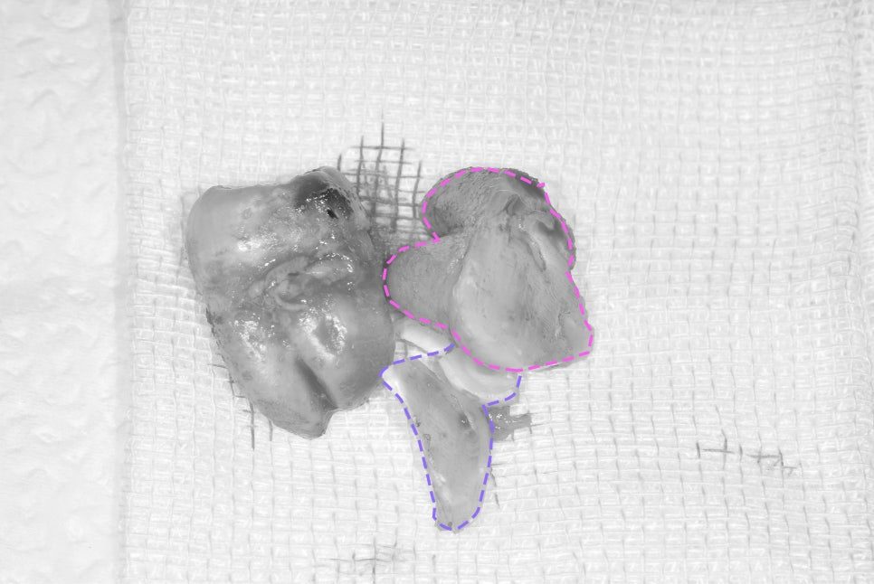 An extracted wisdom tooth on gauze after removal