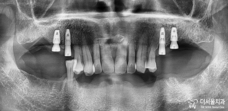 Rebuilding a Mouth After Advanced Bone Loss: Grafting, Then Implants