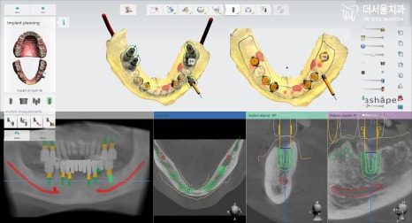 Planning software showing both dental arches from above with the planned implant positions marked
