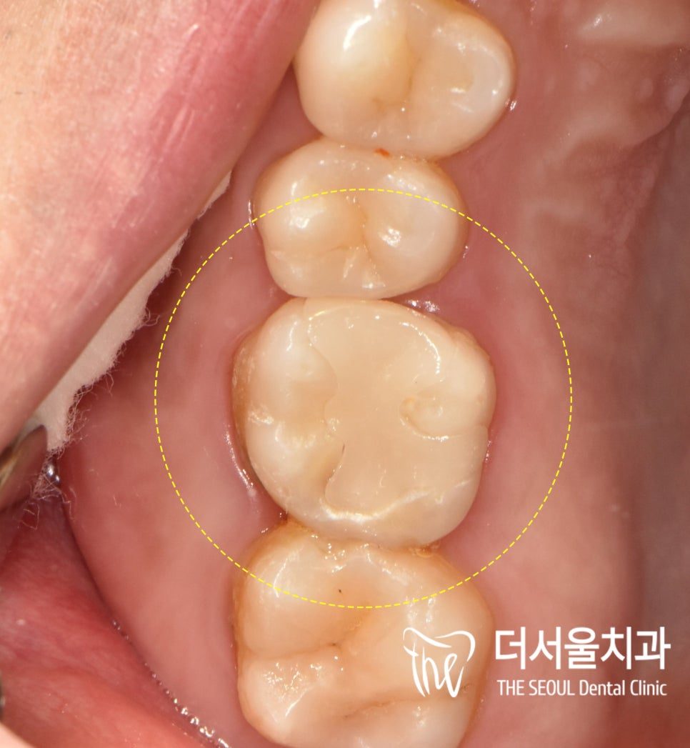 Close-up photograph of a molar with the finished restoration in place, circled