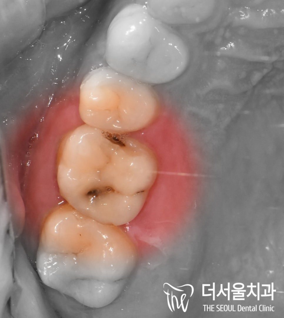 Close-up mirror view of a molar with decay in the grooves of its biting surface