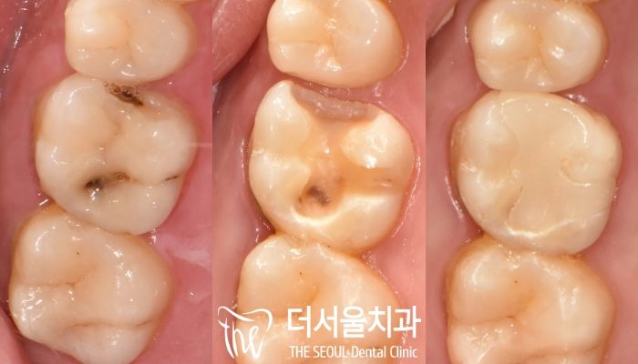 Dental Inlays: What the Five Materials Actually Trade Off