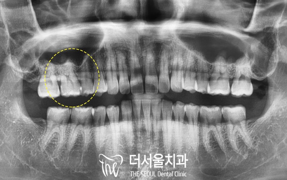 Panoramic dental X-ray with the affected back tooth circled