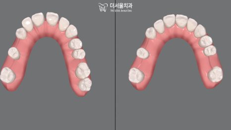 Three-dimensional digital models of the upper and lower arches seen from above