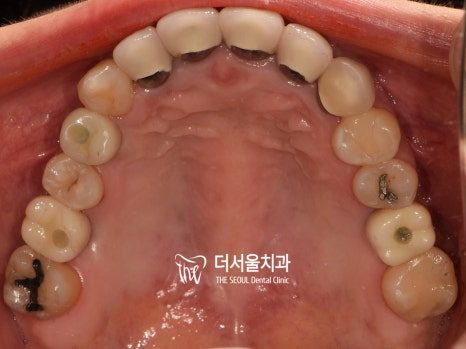 Intraoral photograph of the upper teeth from below showing gaps and worn back teeth