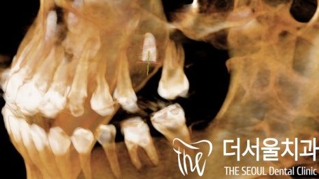 Three-dimensional CT reconstruction of the skull and jaws used for planning