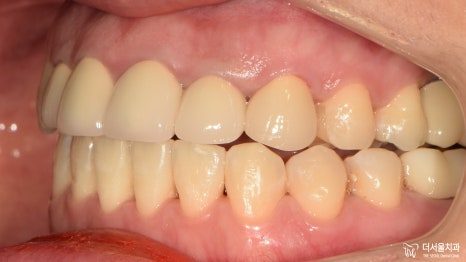 Intraoral photograph of the front teeth in occlusion at the end of treatment