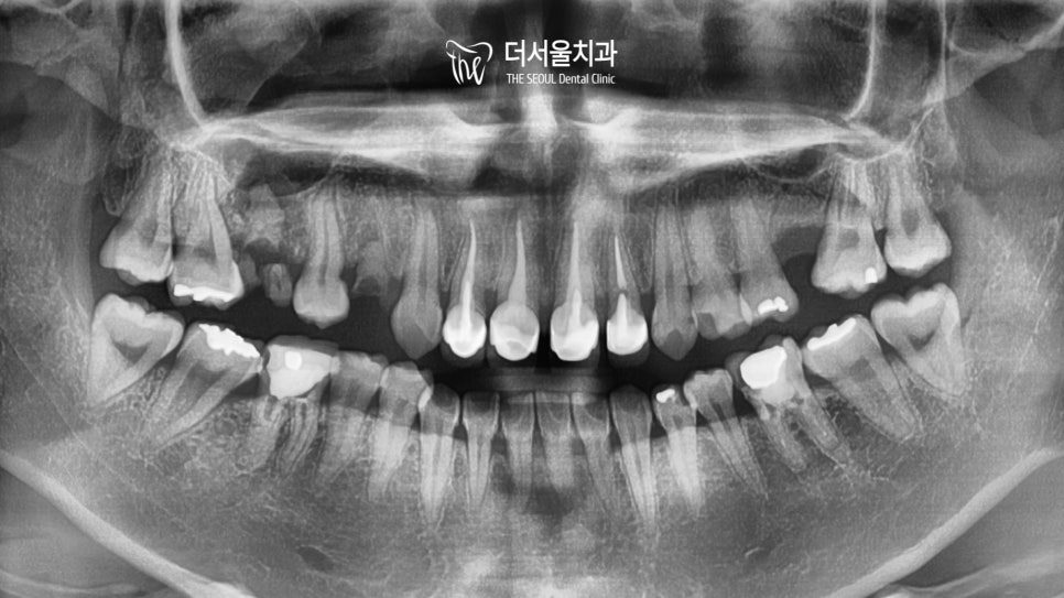 Braces or Implants First? Why the Order Is Not Negotiable