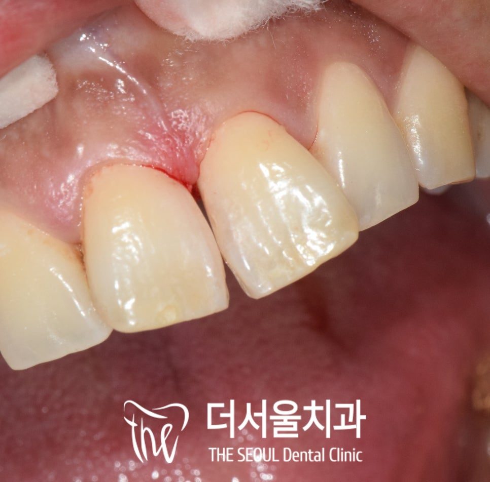 Close-up photograph of the upper front teeth from the side after the filling was placed
