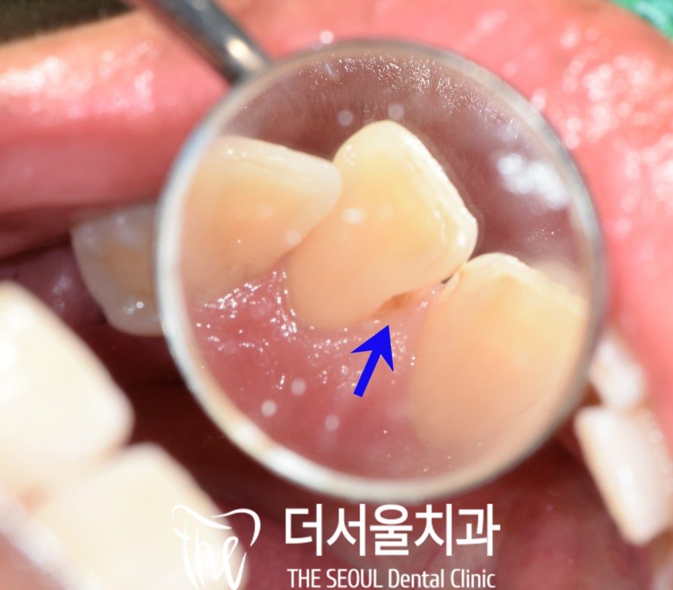 A Cavity Between the Two Front Teeth, Filled in One Visit