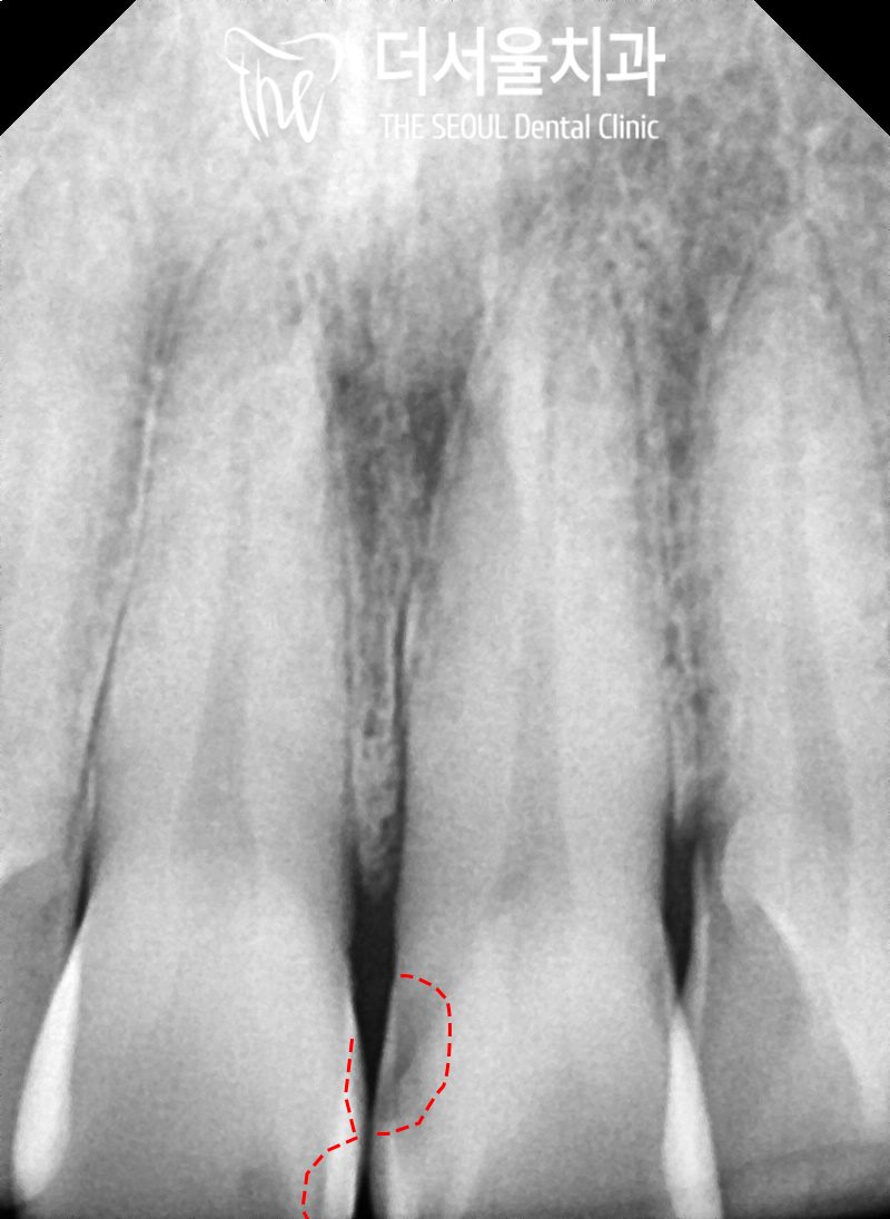 Close-up dental X-ray of the upper front teeth with the area between them circled