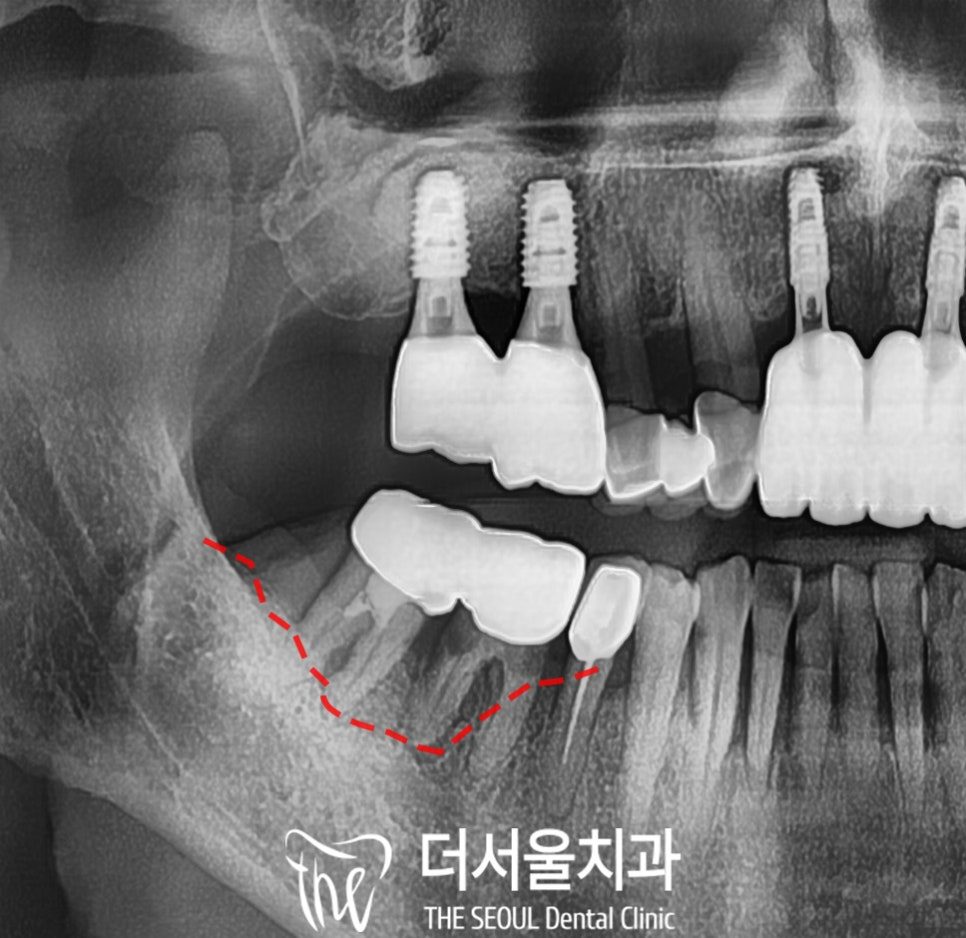 Cropped panoramic dental X-ray with the bone level drawn in as a dashed red line under the back teeth
