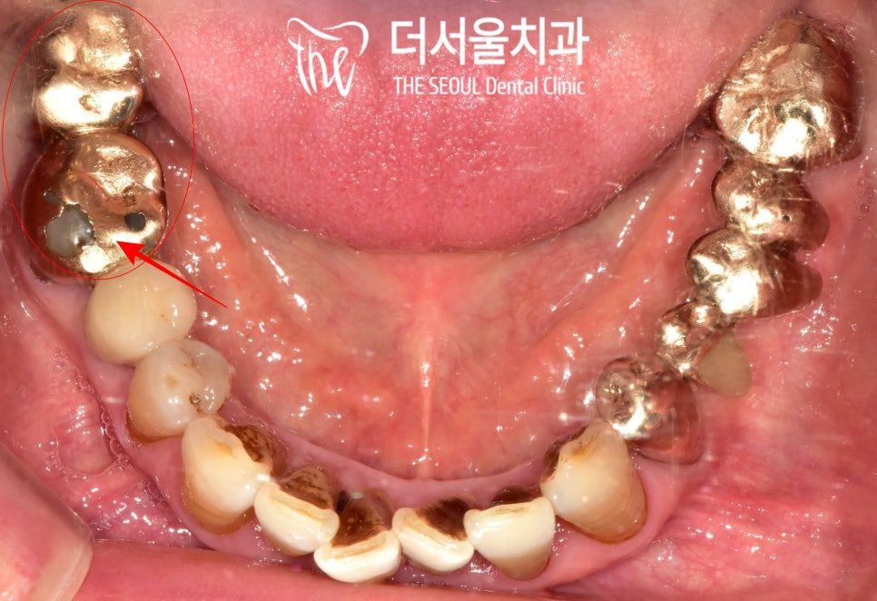 A Gold Crown Worn Through, and Bone Lost to the Furcation