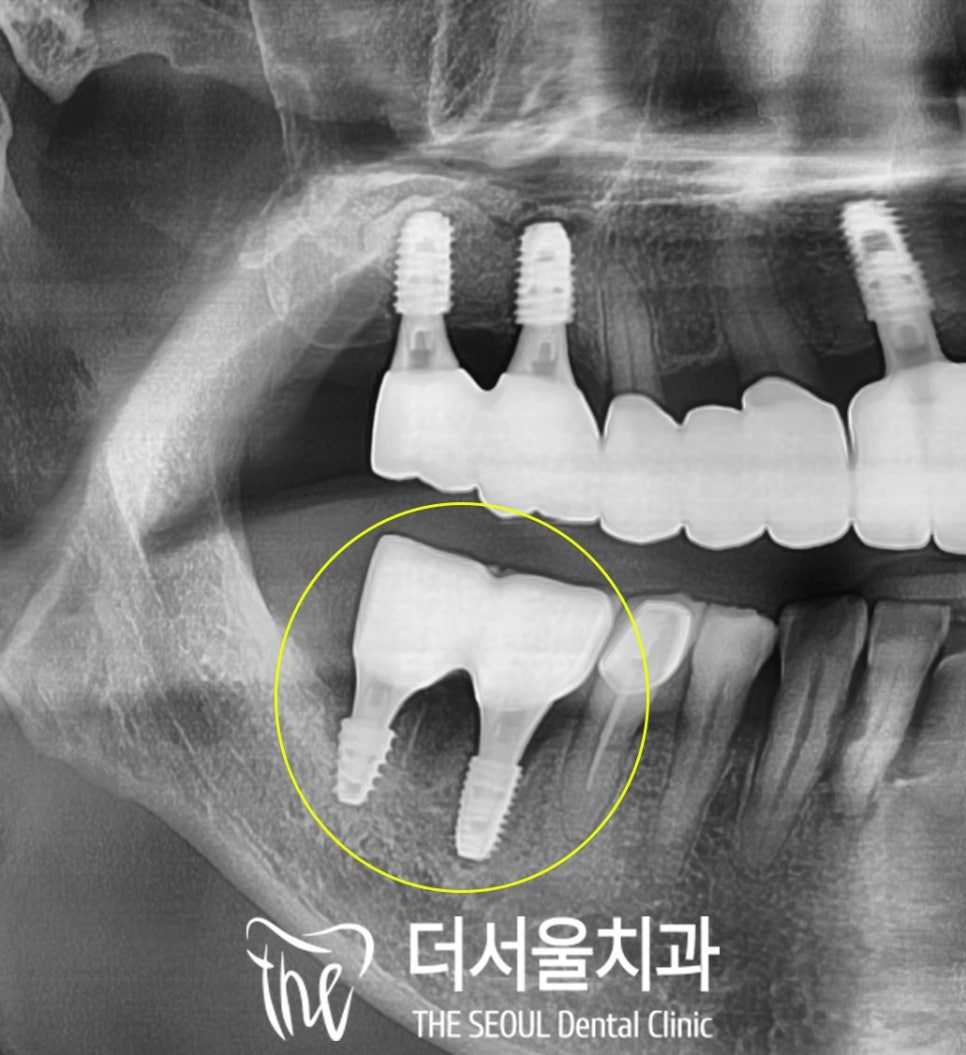 Cropped panoramic dental X-ray with a molar circled where the bone has receded between its roots