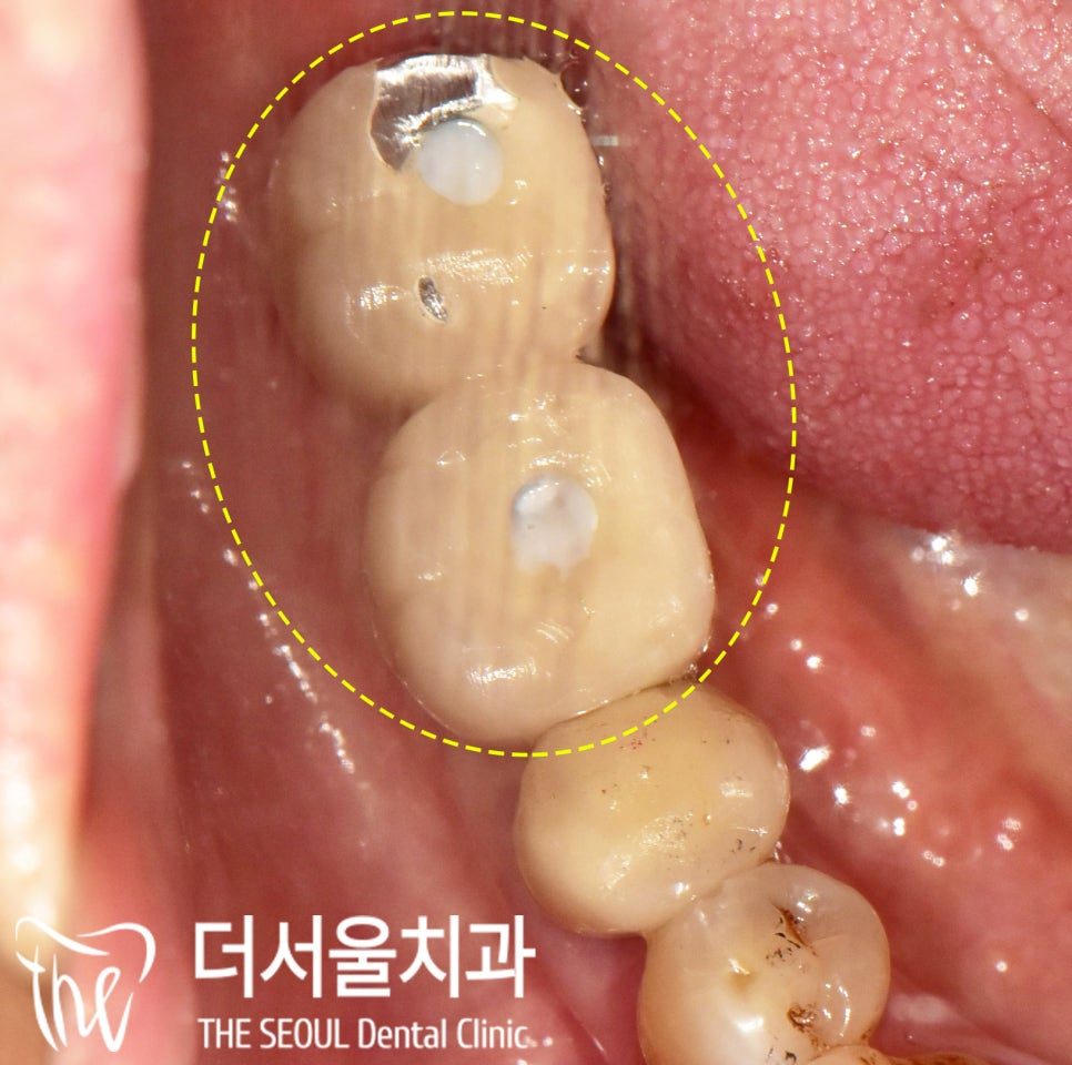 Close-up photograph of the implant components in the mouth, circled