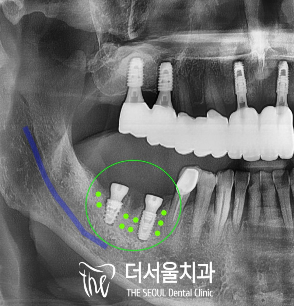 Cropped panoramic dental X-ray with the implant site circled in green and the nerve canal traced in blue