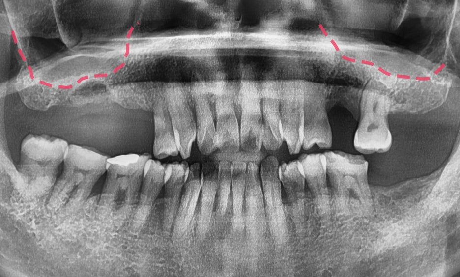 Lateral or Crestal: The Two Ways a Sinus Lift Is Done
