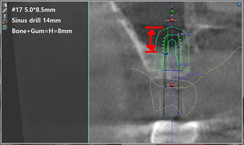 CT cross-section of the upper jaw with the planned implant and the drill depth marked in English