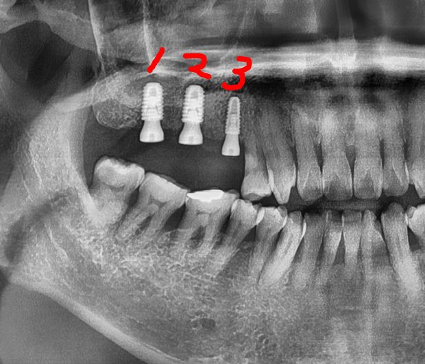 Panoramic dental X-ray with three implant sites numbered in red