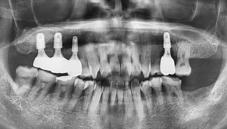 Panoramic dental X-ray showing the implants in place on both sides of the upper jaw