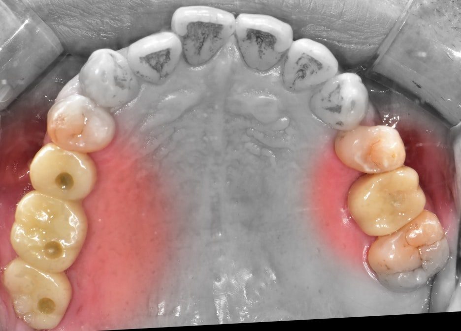 Intraoral photograph of the upper teeth from below showing the back teeth on both sides