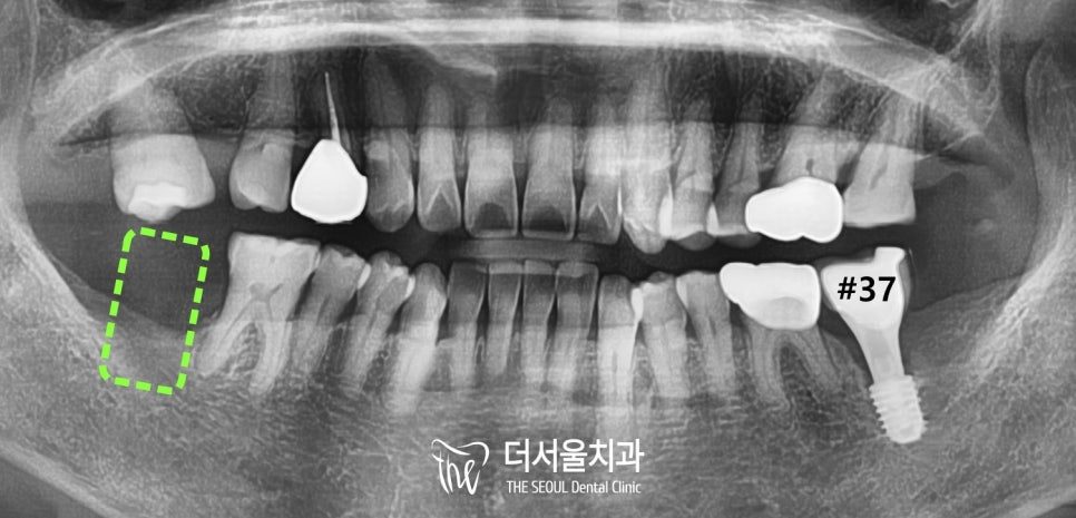 Korea’s National Health Insurance and Dental Implants: What It Covers