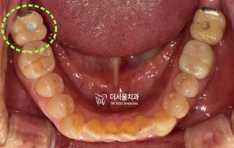 Intraoral photograph of the lower teeth from above with the gap at the back circled
