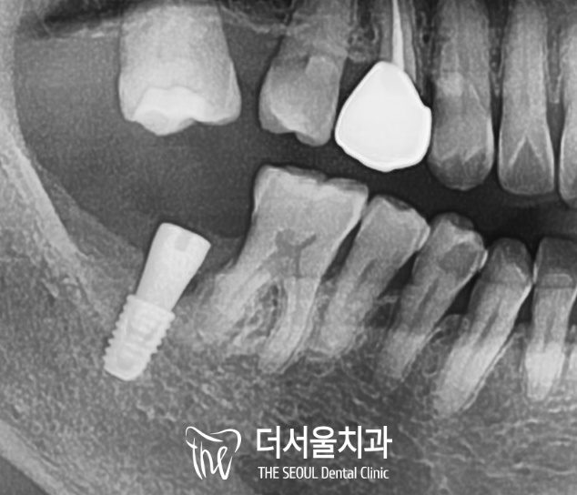 Close-up dental X-ray of the implant seated in the lower jaw