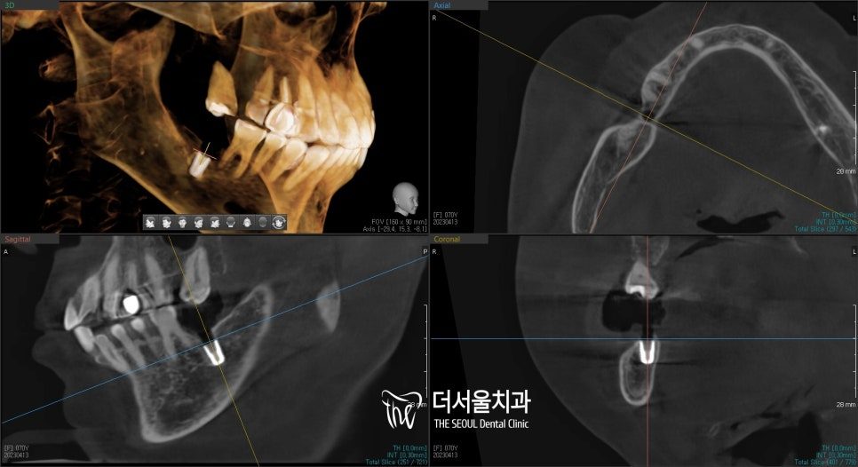 Three-dimensional CT reconstruction of the lower jaw shown beside cross-sections through the implant site