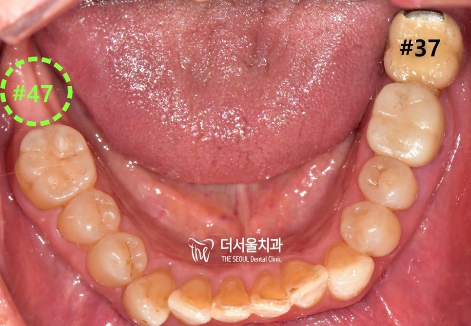 Intraoral photograph of the lower teeth with the finished implant crown at the back, marked with its tooth number