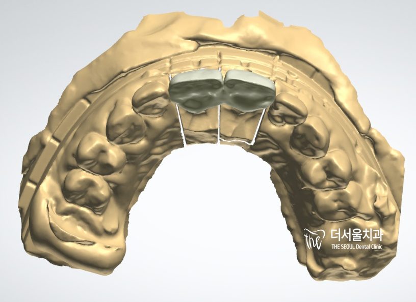 Three-dimensional digital model of the upper arch used to design the crowns