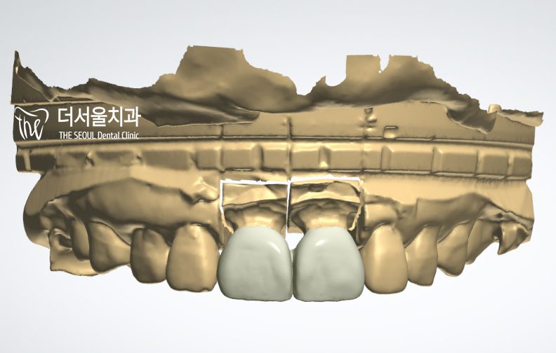 Three-dimensional digital model showing the front teeth from the front, with the planned crowns in place