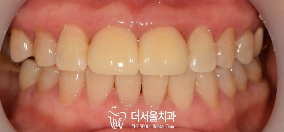 Front Tooth Crowns: PFM, Zirconia or All-Ceramic