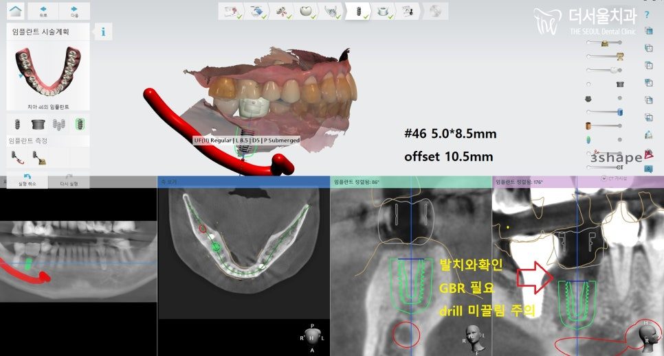 Why Two Implant Crowns Are Sometimes Joined Together