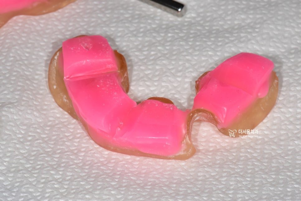 Implant Overdentures: The Middle Option Between Dentures and Full-Arch Implants