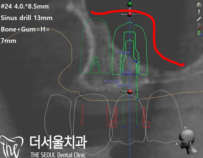 CT cross-section with the planned implant and drill depth marked in English