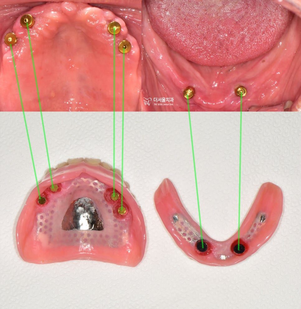 The underside of the denture shown beside the mouth, with lines matching each attachment to the implant it clips onto