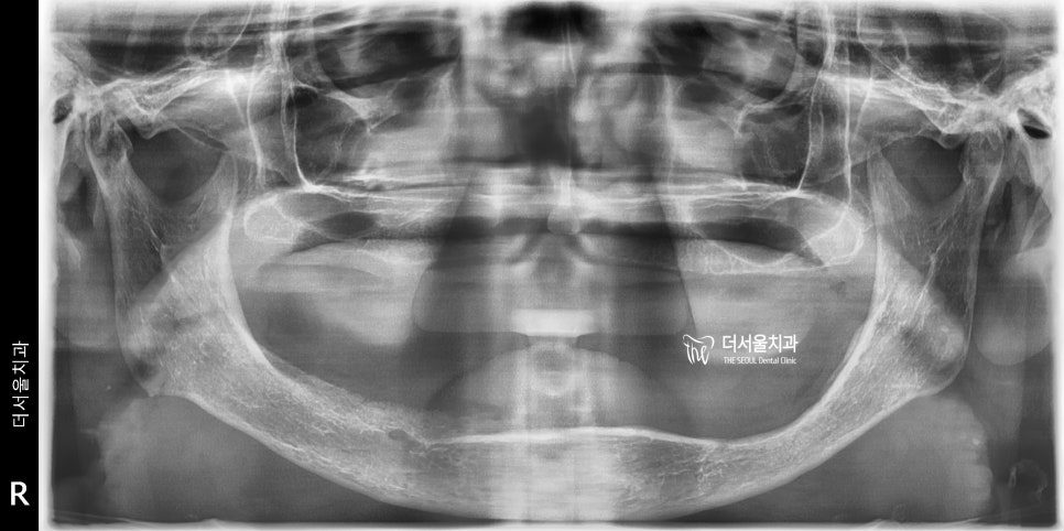 Panoramic dental X-ray of a jaw with no remaining teeth