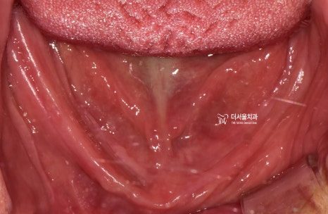 Intraoral photograph of a lower jaw with no teeth, showing the ridge