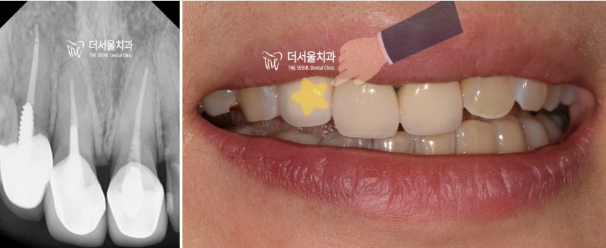 A finished crown shown beside a shade tab held against the teeth to check the colour