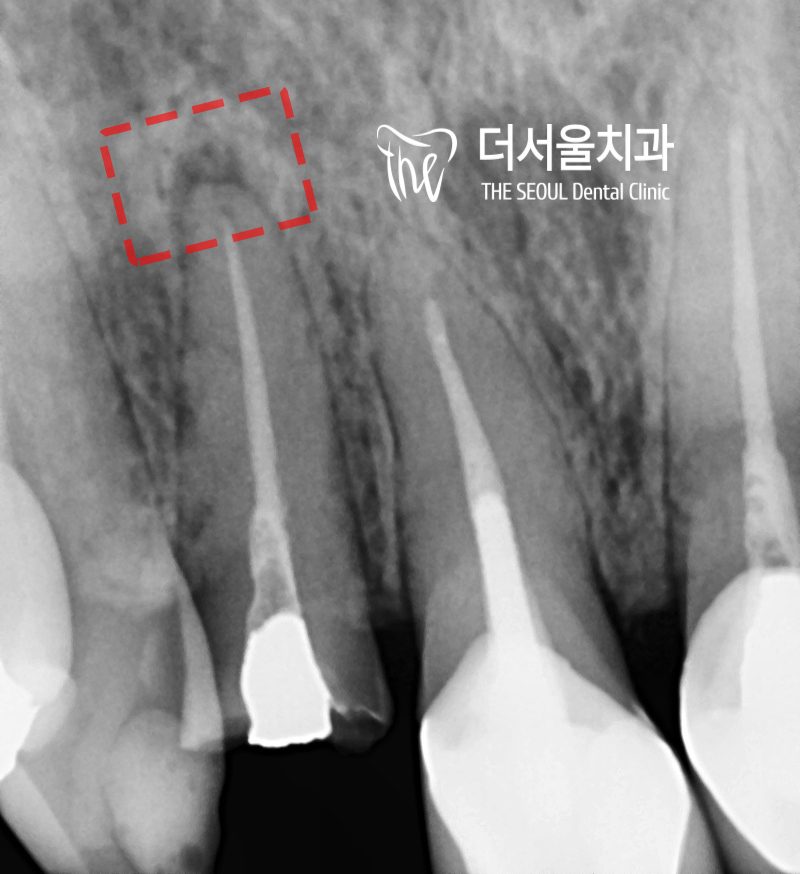 Close-up dental X-ray with the area being retreated boxed in red