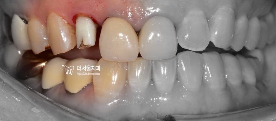 Intraoral photograph of the upper and lower teeth from the side