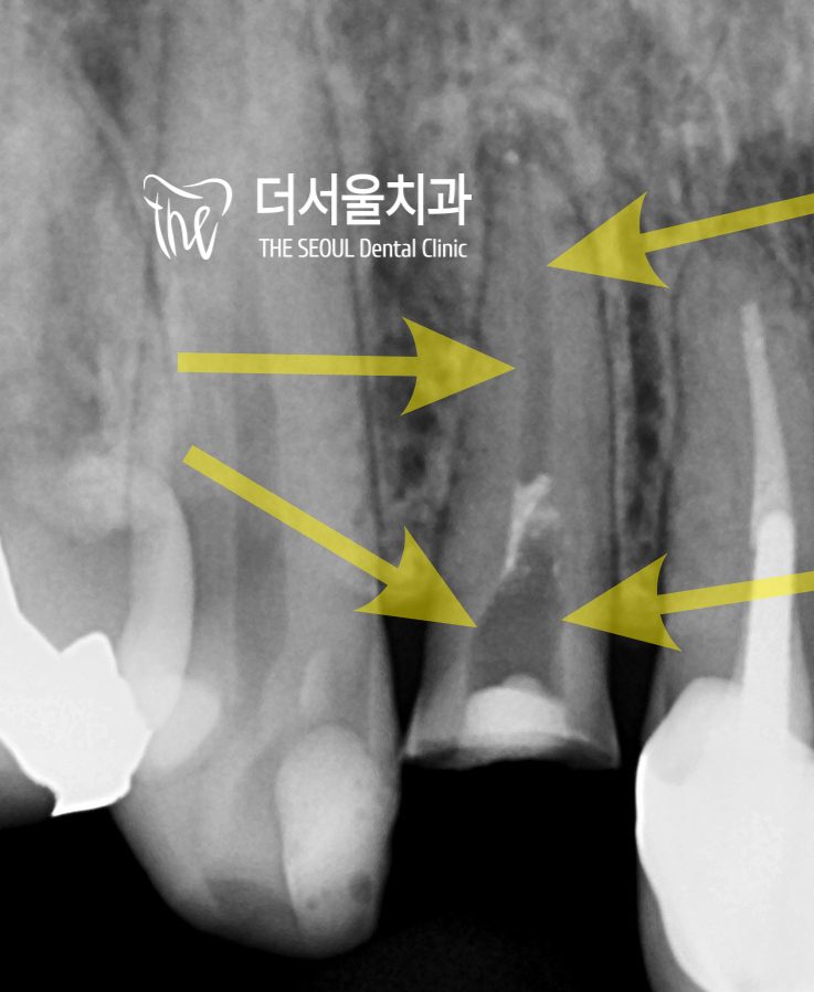 Root Canal Retreatment: When the Patient and the Dentist Want Different Things