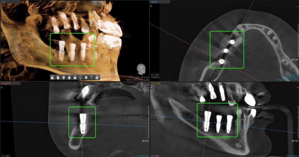 CT views of the jaw with the implant site boxed in green