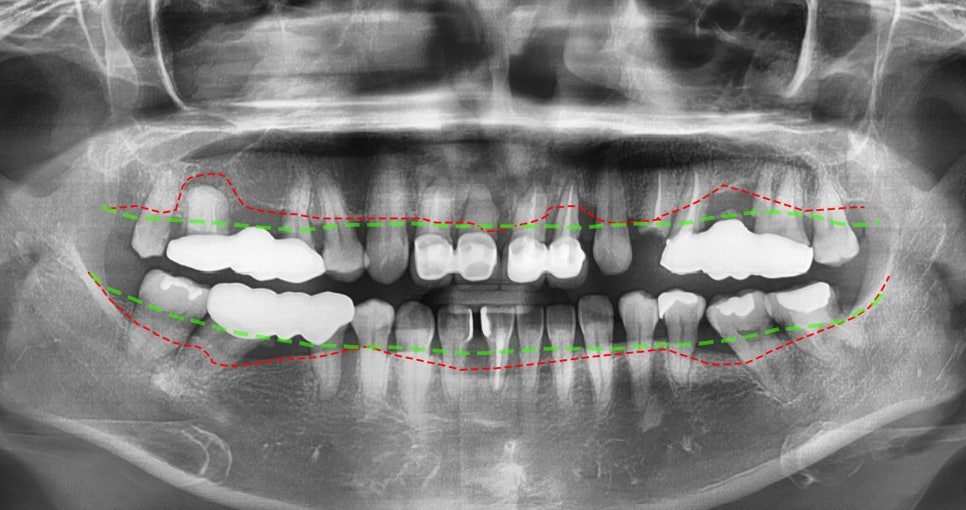 Gum Disease Under a Gold Bridge: Reading Bone Loss on an X-Ray