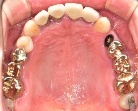 Intraoral photograph of the upper teeth from below with an old gold bridge across the back