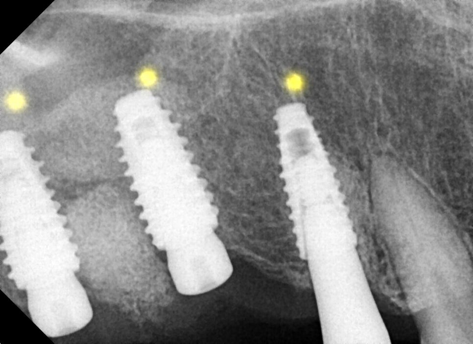 Close-up dental X-ray of three implant fixtures placed in the jaw